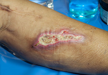 Example Of A Wound CliniMed