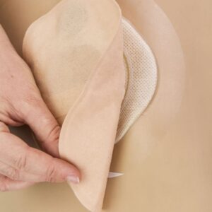 UltraFrame Flange Extenders on someone's skin and a hand pulling the stoma pouch showing the flange