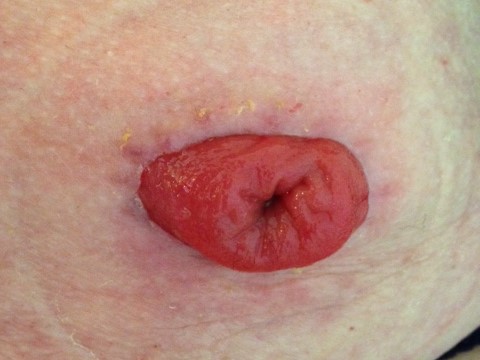 Close-up image of a healthy end colostomy.