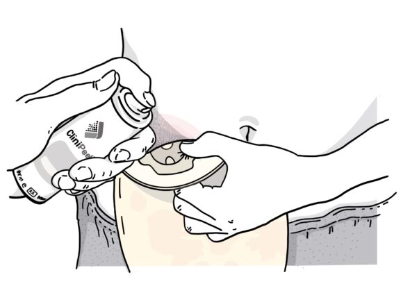 Illustration of a person using CliniPeel Medical Adhesive Remover spray on their stoma bag