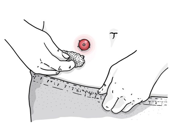 Illustration of someone cleaning the area around their stoma