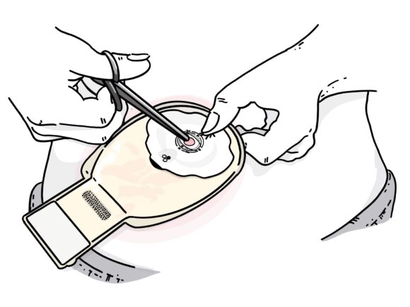 Illustration of a person cutting a stoma bag flange to size