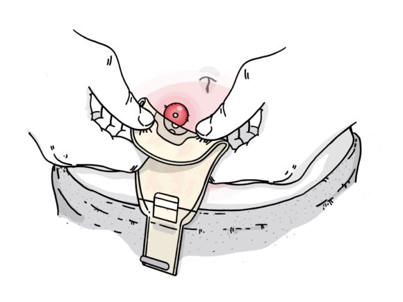 Illustration of a person applying a drainable stoma bag