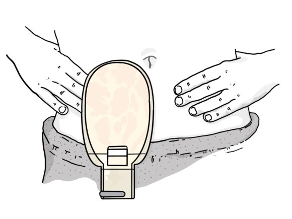 Illustration of a person wearing a drainable stoma bag
