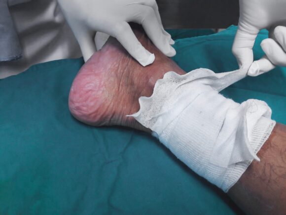 Close up of a healthcare professional removing a dressing from a patient's lower leg.
