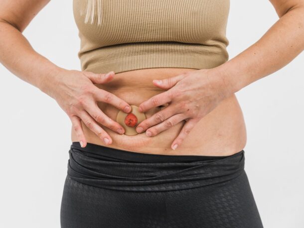 Close up of a person's abdomen and stoma as they apply a Hyperseal washer to it.
