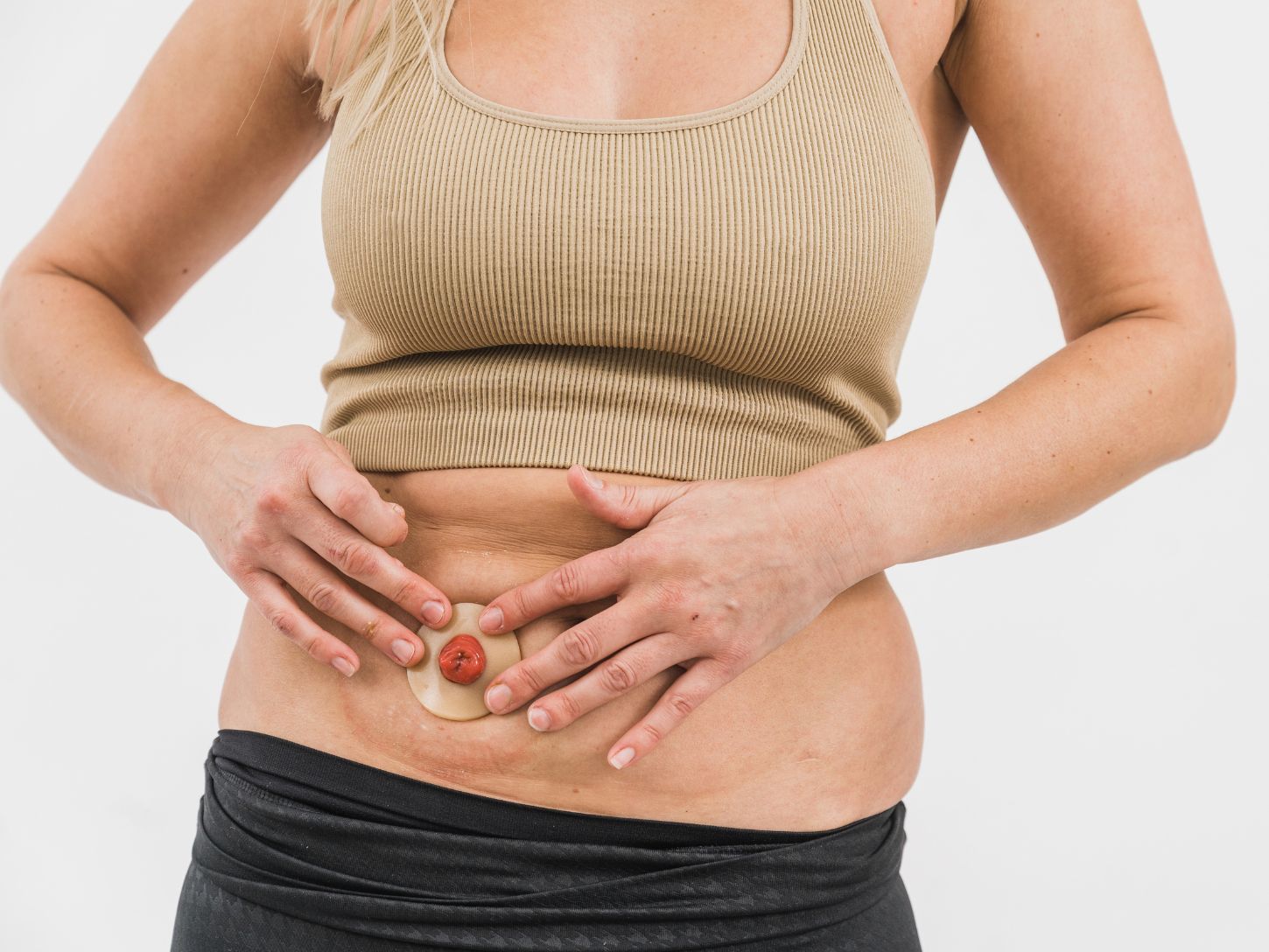 Close up of a person's abdomen and stoma as they apply a Hyperseal washer to it.
