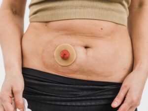 Close up of a person's abdomen and stoma with a Hyperseal washer around it.
