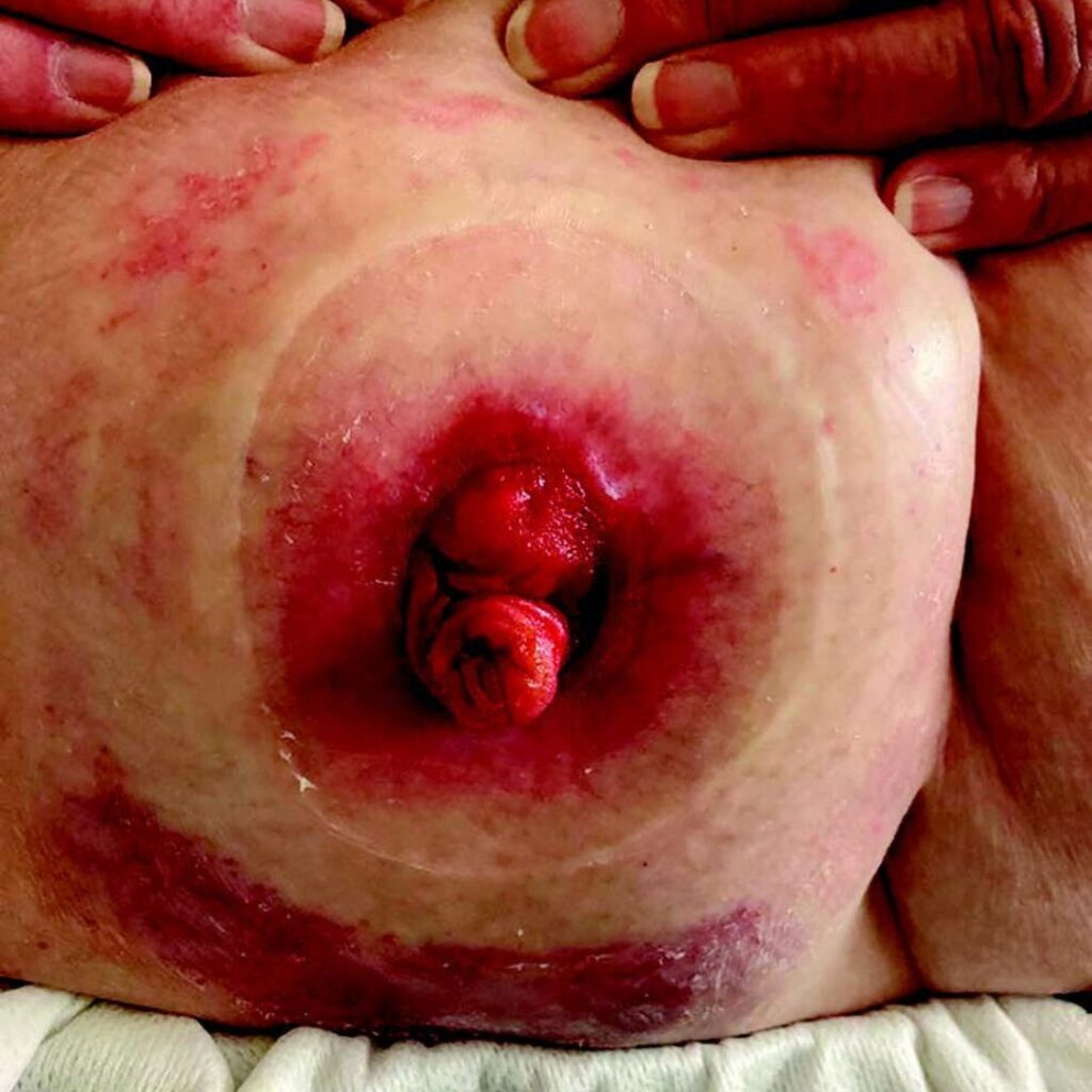A stoma with peristomal skin that has begun to heal from irritation.