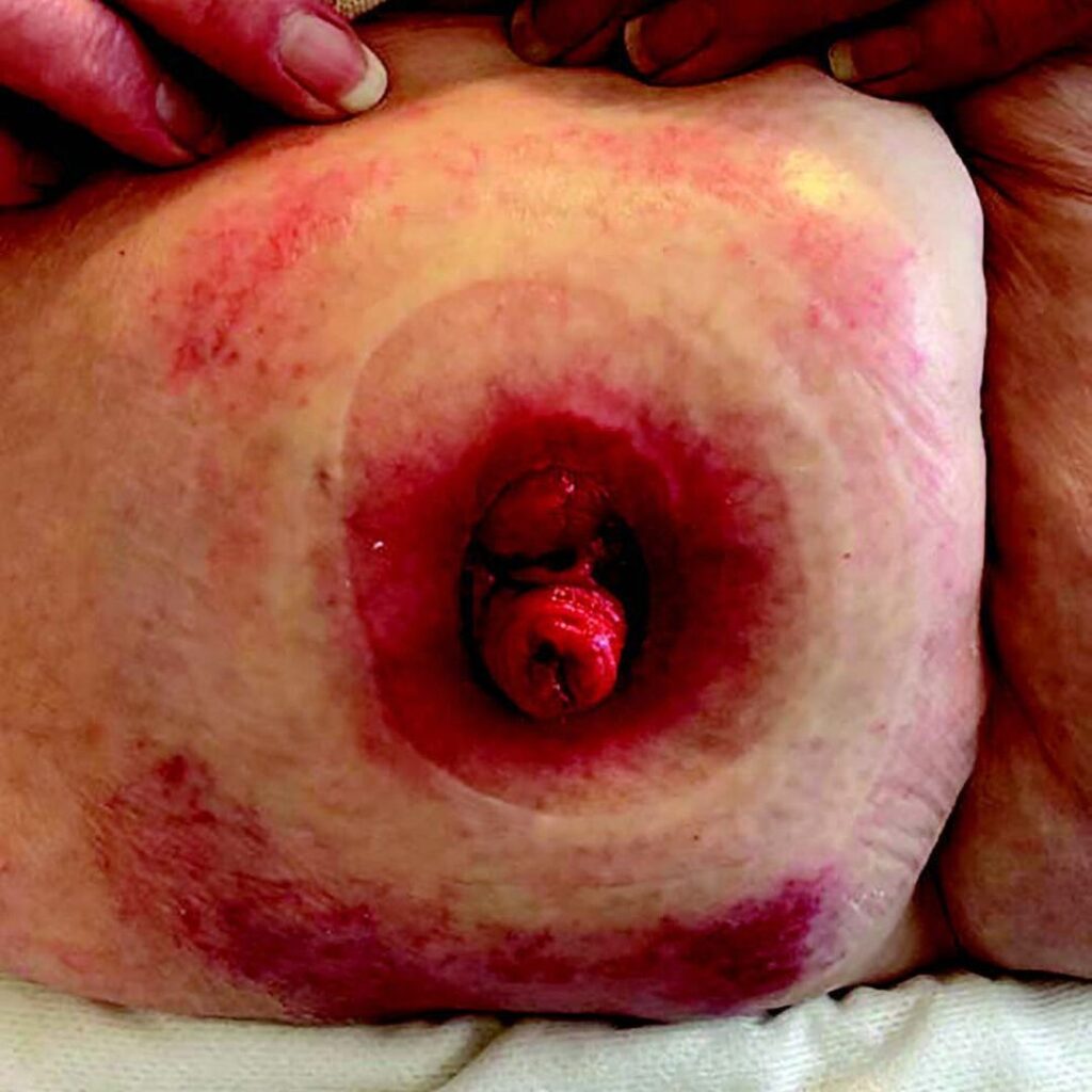 A stoma with injured peristomal skin from leakage and skin stripping.