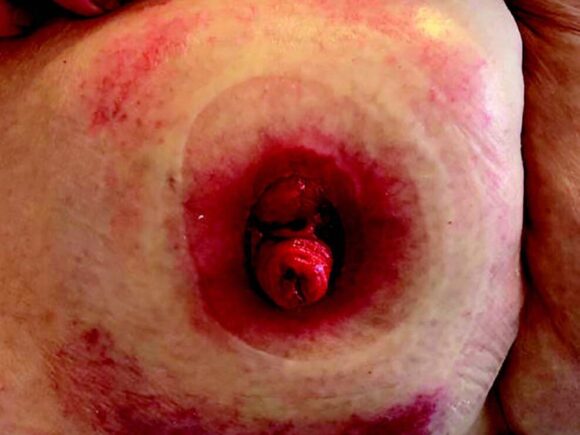 A stoma with injured peristomal skin from leakage and skin stripping.