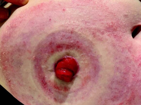 Stoma and peristomal skin ten weeks after trial, showing significant improvements to the skin, reduced redness and no damaged skin.
