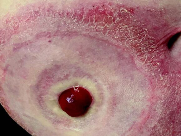 Image of peristomal skin showing improvements to soreness and previously wet skin now beginning to crust as it heals.