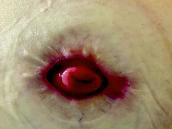 A stoma where the irritated peristomal skin has begun to heal.