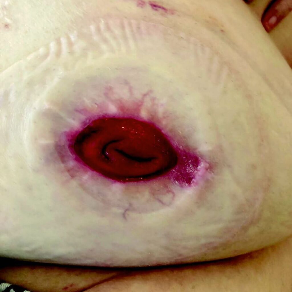 A stoma with visible signs of skin irritation in the peristomal area.