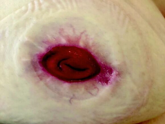 A stoma with visible signs of skin irritation in the peristomal area.