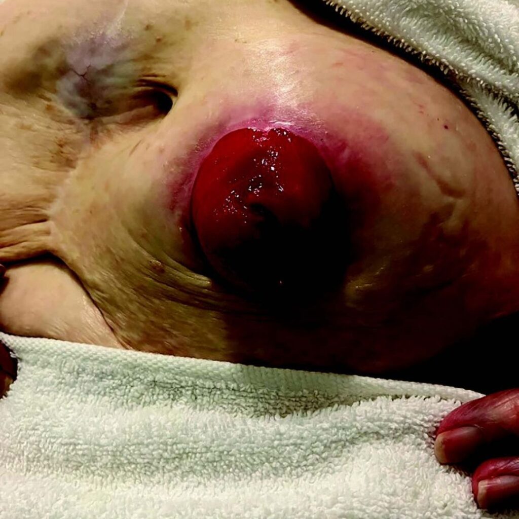 Graphic image of a stoma with parastomal hernia and peristomal skin complications.