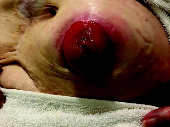 Graphic image of a stoma with parastomal hernia and peristomal skin complications.