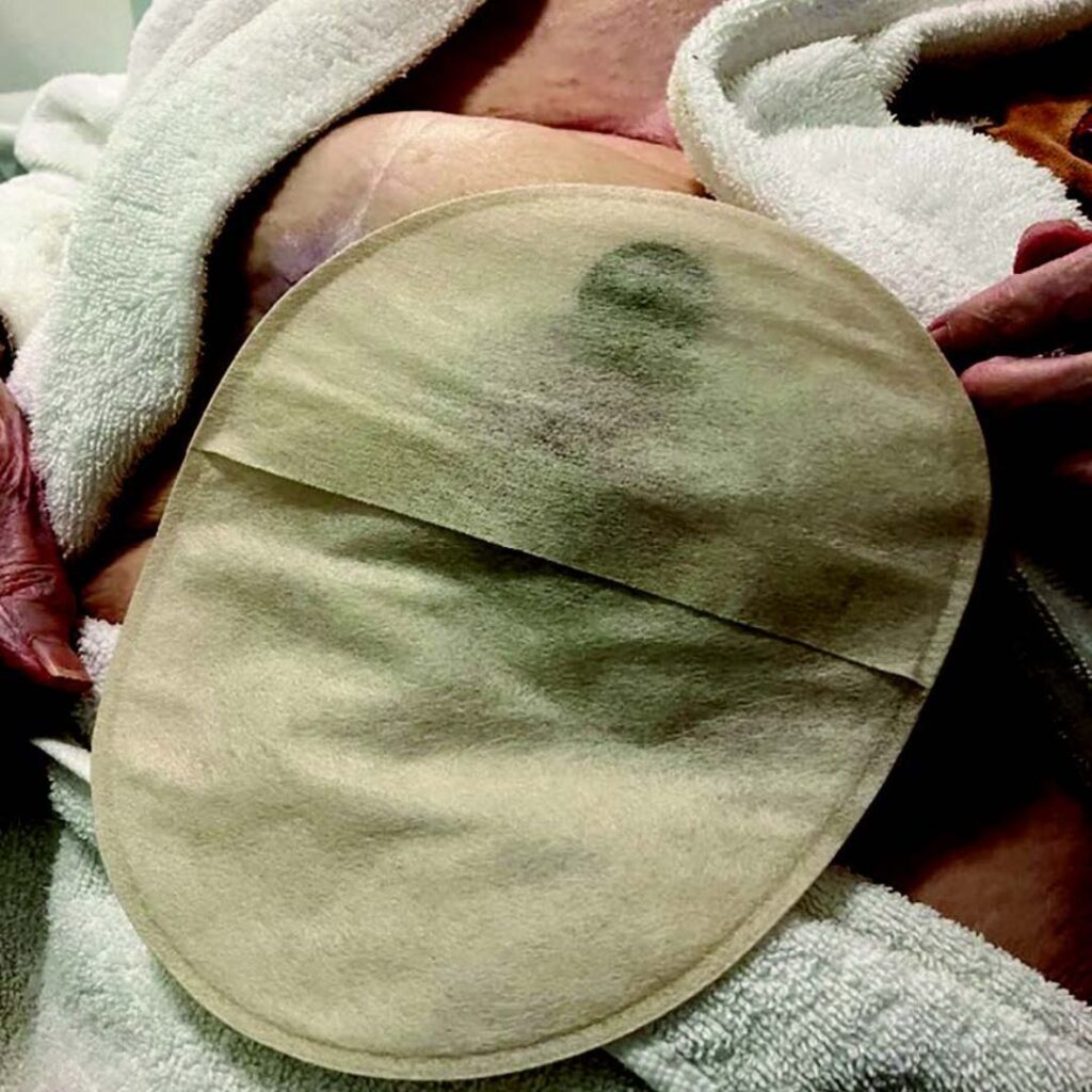 An Aura Plus Soft Convex closed pouch worn by a patient.