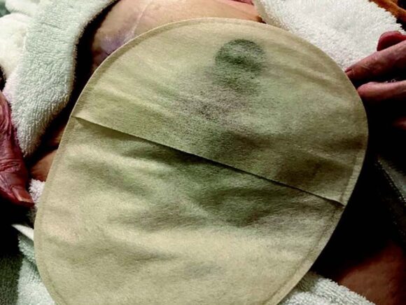 An Aura Plus Soft Convex closed pouch worn by a patient.