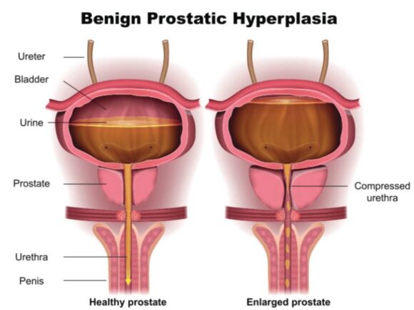 A diagram showing the differences between the urethra in a person with a healthy prostrate and a person with an enlarged prostrate.