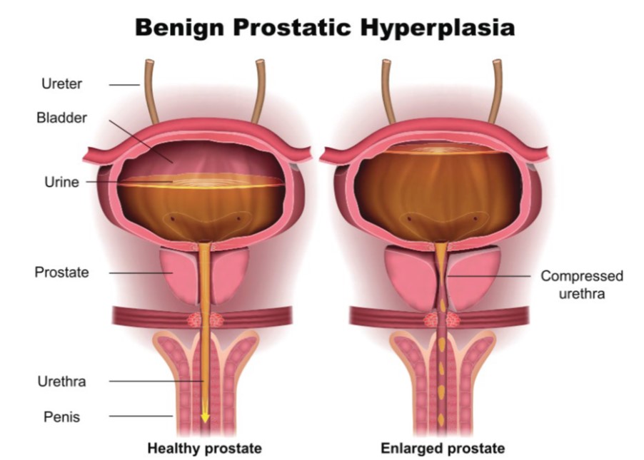 A diagram showing the differences between the urethra in a person with a healthy prostrate and a person with an enlarged prostrate.