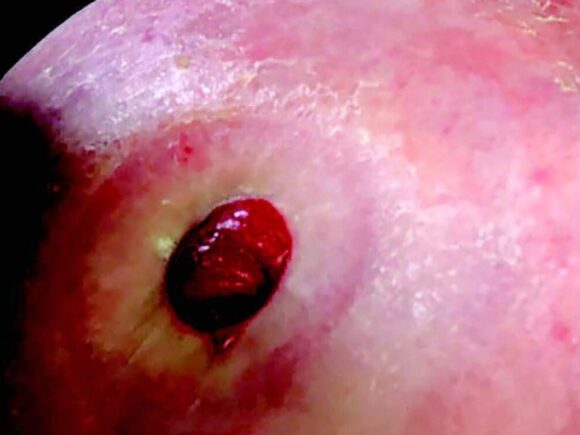 Image of stoma before care review showing extent of peristomal skin damage with visible redness, soreness and injury to skin
