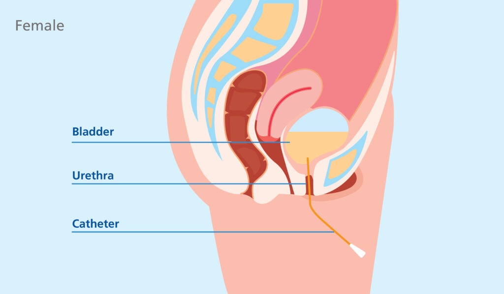An anatomical illustration of a female abdomen from the side.