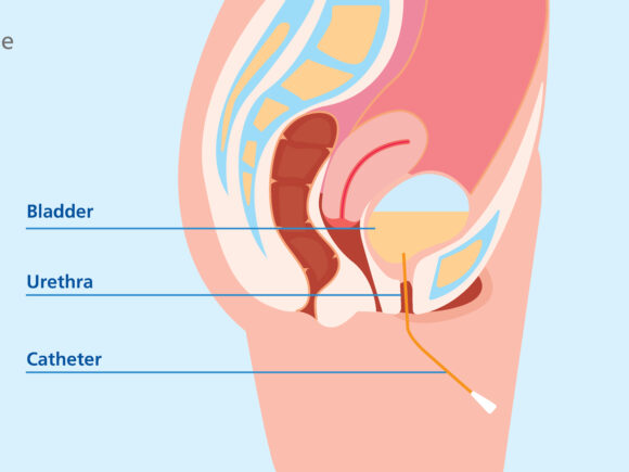 An anatomical illustration of a female abdomen from the side.