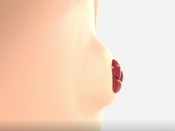 Illustration of a parastomal hernia