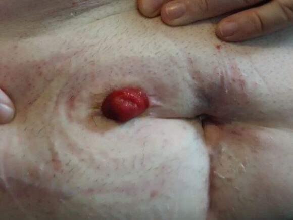 Aaron's abdomen after 12 weeks