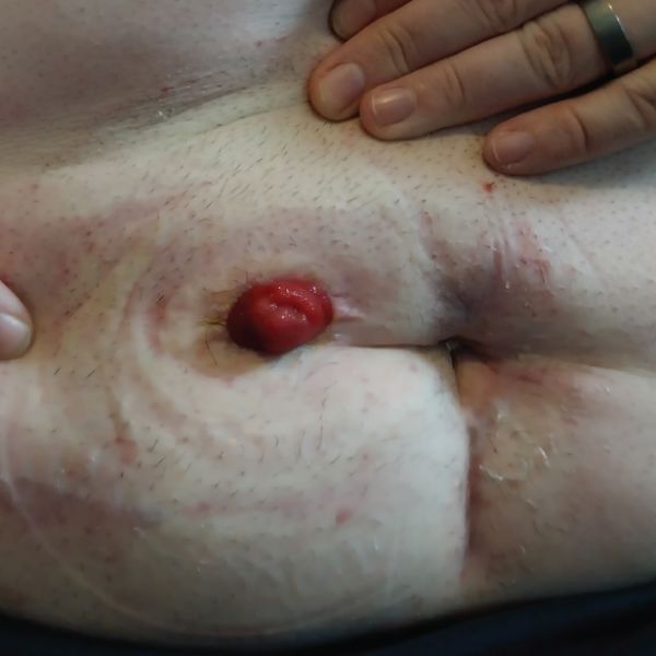 Aaron's abdomen after 12 weeks