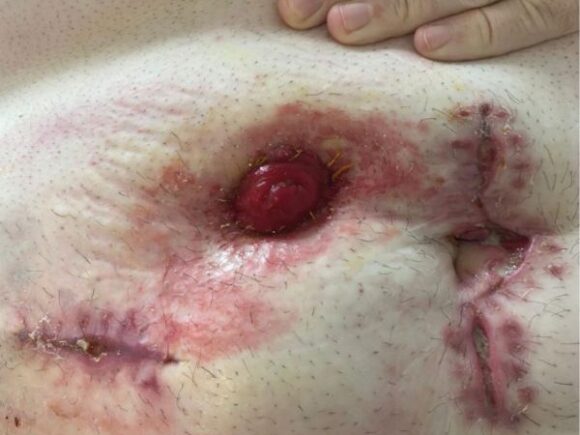 Aaron's abdomen after one week