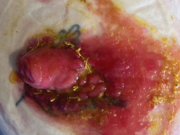 Moisture Associated Skin Damage and effluent