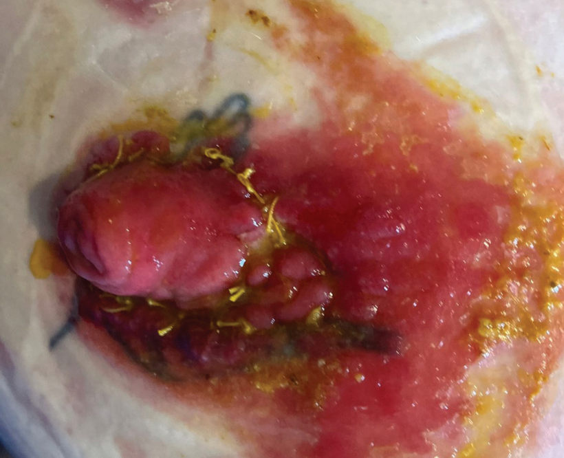 Moisture Associated Skin Damage and effluent