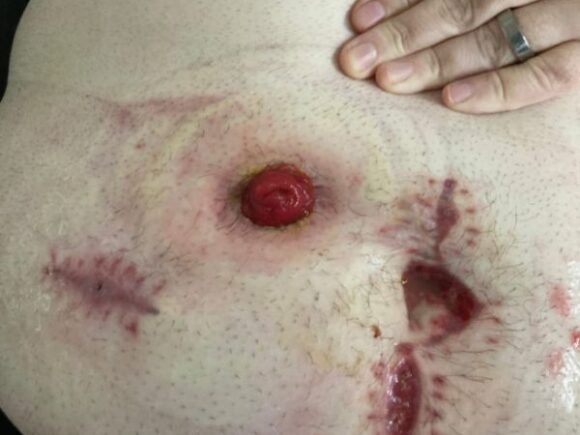 Aaron's abdomen before