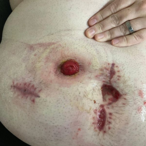 Aaron's abdomen before