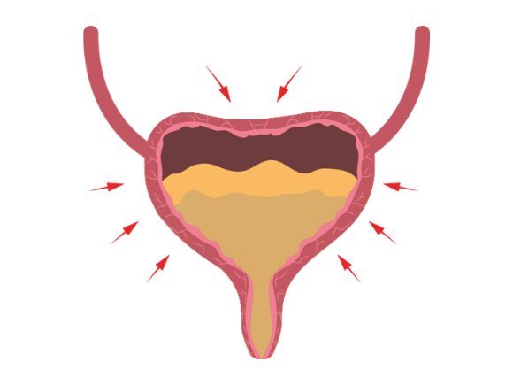 Illustration of an overactive bladder