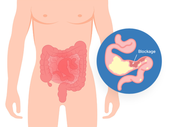 Illustration of the bowels alongside a bowel obstruction