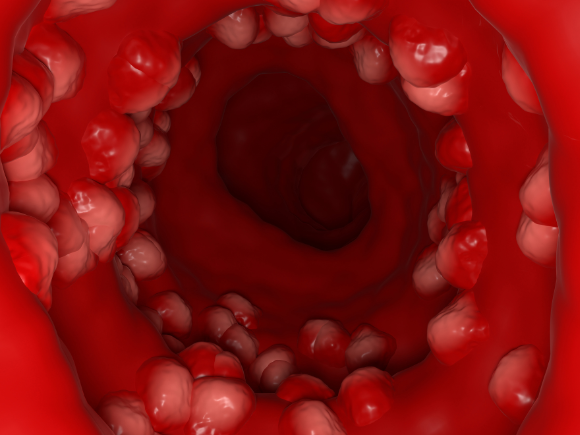 Illustration of ulcerative colitis showing ulcers on the large intestine