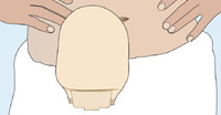 Stoma Pouch Attached
