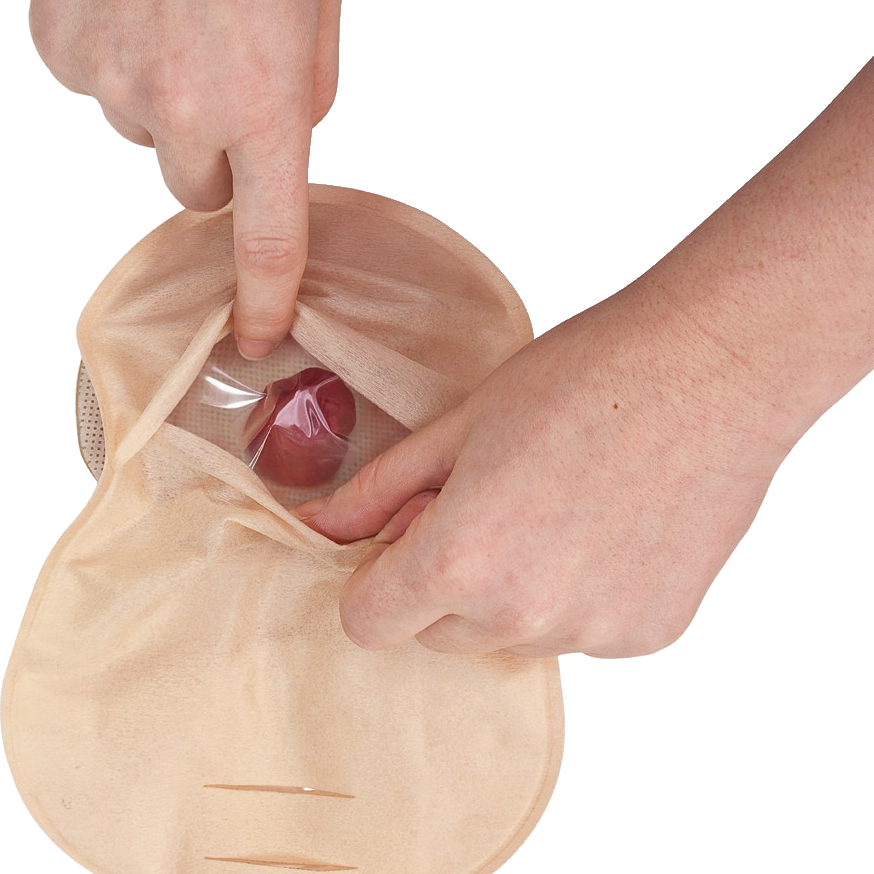 Making sure patients have the ostomy supplies they need - Wound Care Advisor