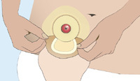 Attaching 2Piece Stoma Bag