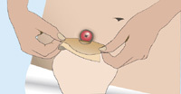 Attaching Stoma Bag