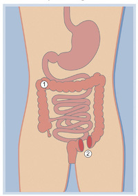 What is a colostomy?