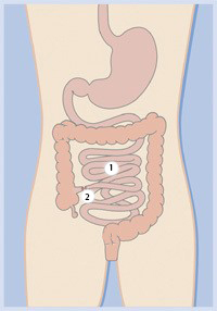 Parts Involved In An Ileostomy